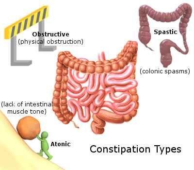 severe constipation after colonoscopy