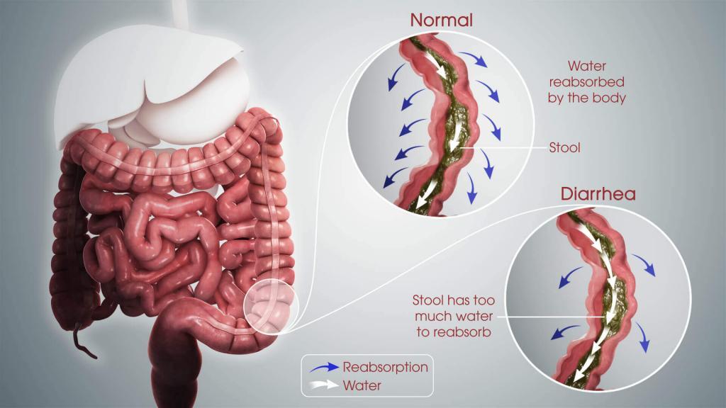 causes-of-diarrhea-diarrhea-abdominal-cramps-ulcers