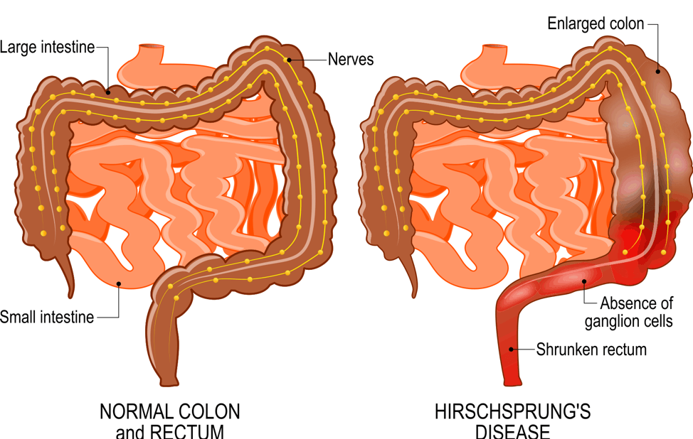Etiology of Acquired Colorectal Disease: Constipation - Constipation