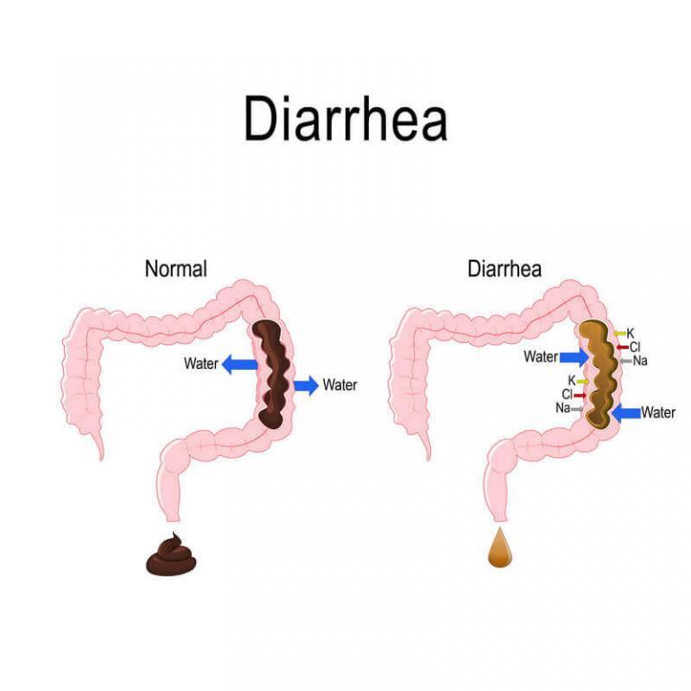 severe-diarrhea-causes-youtube