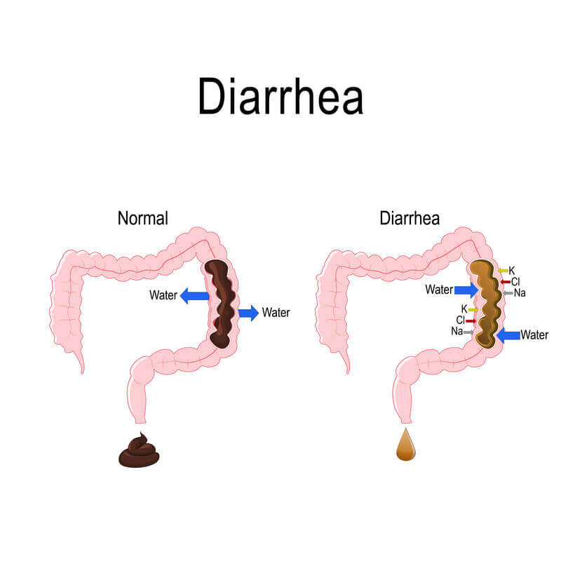 diarrhea-causes-in-women